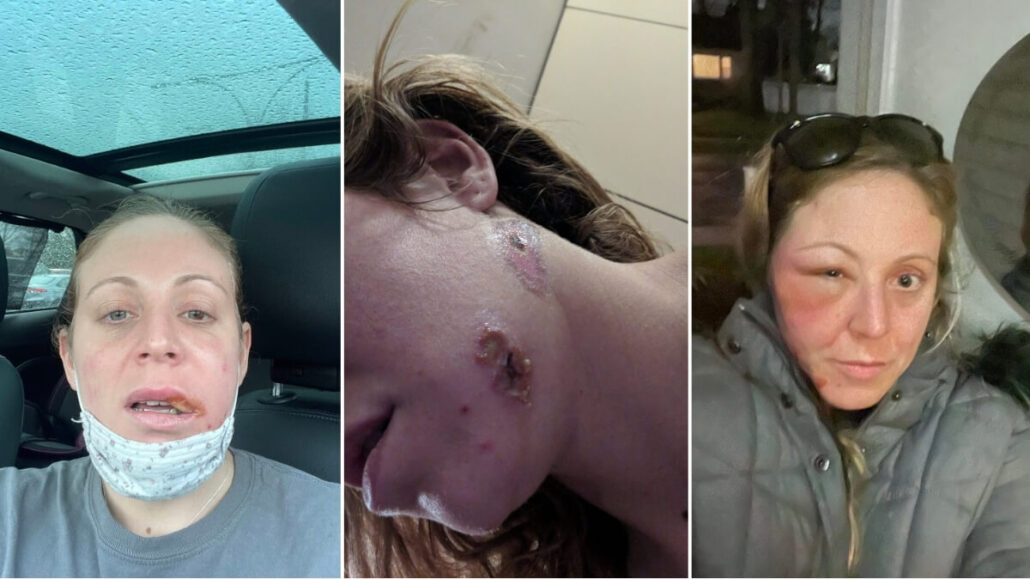 A collage of three photos shows a woman with facial injuries after swimming with pigs in the Bahamas: in a car with a swollen lip, a close-up of neck sores possibly from a parasite, and facial swelling while wearing a jacket.